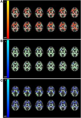 White matter abnormalities and multivariate pattern analysis in anti-NMDA receptor encephalitis